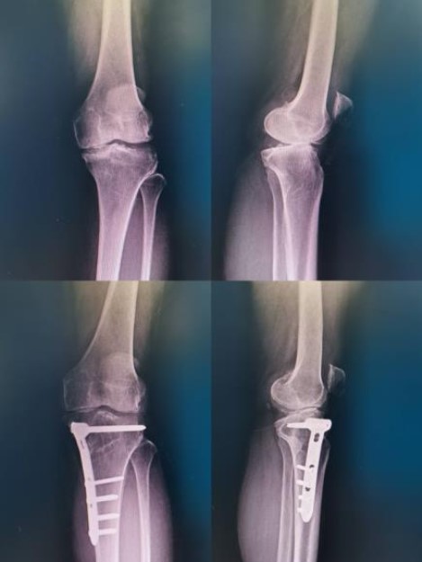 Radiography taken before and after undergoing HTO without bone graft